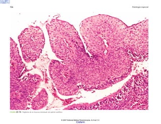 726 Patología especial
FIGURA 22-14. Papiloma de la mucosa sinonasal con patrón exofítico.
© 2007 Editorial Médica Panamericana, S.A de C.V.
Cisfarm
 