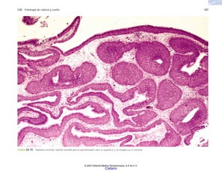 C22 Patología de cabeza y cuello 727
FIGURA 22-15. Papiloma invertido. Epitelio estratificado no queratinizado cubre la superficie y se invagina en el estroma.
© 2007 Editorial Médica Panamericana, S.A de C.V.
Cisfarm
 