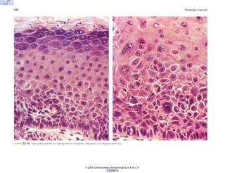728 Patología especial
FIGURA 22-16. Hiperplasia epitelial con hiperqueratosis (izquierda). Hiperplasia con displasia (derecha).
© 2007 Editorial Médica Panamericana, S.A de C.V.
Cisfarm
 