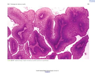 C22 Patología de cabeza y cuello 729
FIGURA 22-17. Papiloma laríngeo. Papilas revestidas por epitelio escamoso no queratinizado.
© 2007 Editorial Médica Panamericana, S.A de C.V.
Cisfarm
 