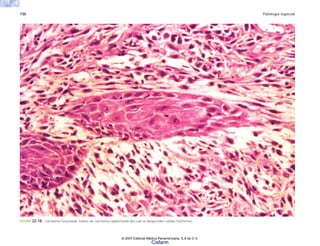 730 Patología especial
FIGURA 22-18. Carcinoma fusocelular. Islotes de carcinoma epidermoide del cual se desprenden células fusiformes.
© 2007 Editorial Médica Panamericana, S.A de C.V.
Cisfarm
 