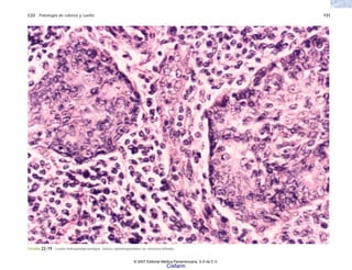 C22 Patología de cabeza y cuello 731
FIGURA 22-19. Lesión linfoepitelial benigna. Islotes epimioepiteliales en estroma linfoide.
© 2007 Editorial Médica Panamericana, S.A de C.V.
Cisfarm
 