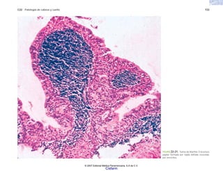 C22 Patología de cabeza y cuello 733
FIGURA 22-21. Tumor de Warthin. Estructura
papilar formada por tejido linfoide revestido
por oncocitos.
© 2007 Editorial Médica Panamericana, S.A de C.V.
Cisfarm
 