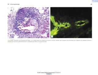 C5 Inmunopatología 69
FIGURA 5-7. Vasculitis en el fenómeno de Arthus. a) La mitad inferior de la pared de la vena es normal, mientras que la superior está destruida por el depósito de complejos inmunes e
invasión por leucocitos polimorfonucleares. b) Depósito de fibrina en la pared vascular.
(a) (b)
© 2007 Editorial Médica Panamericana, S.A de C.V.
Cisfarm
 
