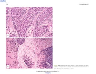 734 Patología especial
FIGURA 22-22. Adenoma de células basales. a) Islotes epiteliales con células
periféricas en empalizada descansando sobre membrana basal prominente. b)
Nidos epiteliales con material amorfo hialino.
(a)
(b)
© 2007 Editorial Médica Panamericana, S.A de C.V.
Cisfarm
 