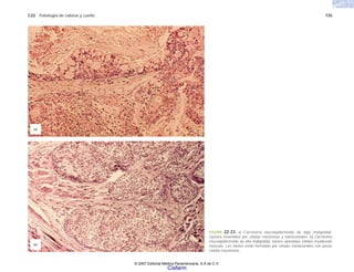 C22 Patología de cabeza y cuello 735
FIGURA 22-23. a) Carcinoma mucoepidermoide de baja malignidad.
Quistes revestidos por células mucinosas y transicionales. b) Carcinoma
mucoepidermoide de alta malignidad. Islotes epiteliales sólidos invadiendo
músculo. Los islotes están formados por células transicionales con pocas
células mucinosas.
(a)
(b)
© 2007 Editorial Médica Panamericana, S.A de C.V.
Cisfarm
 