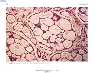736 Patología especial
FIGURA 22-24. Carcinoma adenoide quístico. Células neoplásicas pequeñas en patrón cribiforme.
© 2007 Editorial Médica Panamericana, S.A de C.V.
Cisfarm
 