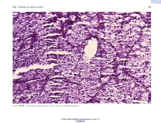 C22 Patología de cabeza y cuello 737
FIGURA 22-25. Carcinoma de células acinosas. Células ovoides con citoplasma granular.
© 2007 Editorial Médica Panamericana, S.A de C.V.
Cisfarm
 