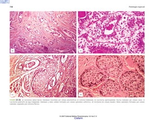 738 Patología especial
FIGURA 22-26. a) Carcinoma salival ductal. Glándulas revestidas por células pleomórficas en estroma hialinizado. b) Carcinoma epimioepitelial. Ductos rodeados por células claras. c)
Carcinoma polimorfo de baja malignidad. Glándulas y nidos sólidos formados por células epiteliales uniformes. d) Carcinoma de células basales. Nidos epiteliales formados por células
redondas separados por estroma fibroso.
(a) (b)
(c) (d)
© 2007 Editorial Médica Panamericana, S.A de C.V.
Cisfarm
 
