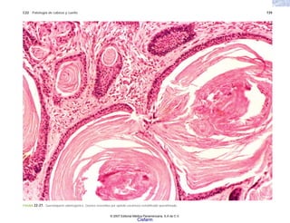 C22 Patología de cabeza y cuello 739
FIGURA 22-27. Queratoquiste odontogénico. Quistes revestidos por epitelio escamoso estratificado queratinizado.
© 2007 Editorial Médica Panamericana, S.A de C.V.
Cisfarm
 