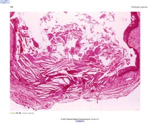 740 Patología especial
FIGURA 22-28. Quiste radicular.
© 2007 Editorial Médica Panamericana, S.A de C.V.
Cisfarm
 