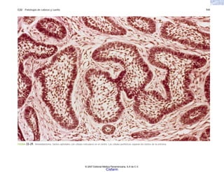 C22 Patología de cabeza y cuello 741
FIGURA 22-29. Ameloblastoma. Islotes epiteliales con células reticulares en el centro. Las células periféricas separan los islotes de la estroma.
© 2007 Editorial Médica Panamericana, S.A de C.V.
Cisfarm
 