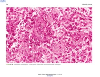 742 Patología especial
FIGURA 22-30. Granuloma de células gigantes. Células gigantes multinucleadas en estroma fusocelular hemorrágico.
© 2007 Editorial Médica Panamericana, S.A de C.V.
Cisfarm
 