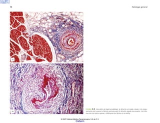70 Patología general
FIGURA 5-8. Vasculitis de hipersensibilidad. a) Arteritis en tejido celular, con engro-
samiento de la pared y fibrosis perivascular. b) Arteritis aguda necrosante, con des-
trucción de toda la pared e infiltración de fibrina en la íntima.
(a)
(b)
© 2007 Editorial Médica Panamericana, S.A de C.V.
Cisfarm
 