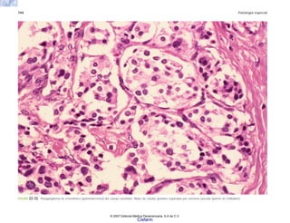 744 Patología especial
FIGURA 22-32. Paraganglioma no cromafínico (quimiodectoma) del cuerpo carotídeo. Nidos de células grandes separadas por estroma vascular (patrón en Zellballen).
© 2007 Editorial Médica Panamericana, S.A de C.V.
Cisfarm
 
