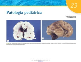 23
Patología pediátrica
Eduardo López Corella
Cecilia Ridaura Sanz
Patología pediátrica
FIGURA 23-1. a) Hemorragia cerebral de la matriz germinativa con extensión parenquimatosa, que llena los ventrículos laterales y el tercer ventrículo, y b) forma un hematoma en la cisterna
magna en este cerebro marcadamente inmaduro.
(a)
(b)
© 2007 Editorial Médica Panamericana, S.A de C.V.
Cisfarm
 