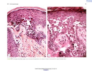 C5 Inmunopatología 71
(a) (b)
FIGURA 5-9. Histología del pénfigo vulgar. a) y b), vesículas intraepiteliales con células de Tzanck. (Cortesía del Dr. Jorge Fernández Díez.)
© 2007 Editorial Médica Panamericana, S.A de C.V.
Cisfarm
 