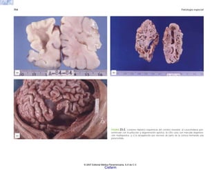 754 Patología especial
FIGURA 23-2. Lesiones hipóxico isquémicas del cerebro neonatal. a) Leucomalacia peri-
ventricular con licuefacción y degeneración quística. b) Otro caso con marcada degenera-
ción multiquística, y c) la desaparición por necrosis de parte de la corteza formando una
porencefalia.
(a) (b)
(c)
© 2007 Editorial Médica Panamericana, S.A de C.V.
Cisfarm
 