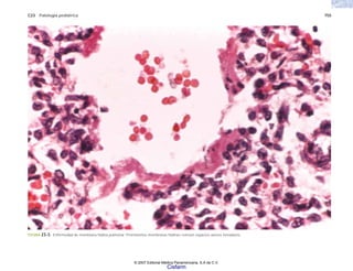C23 Patología pediátrica 755
FIGURA 23-3. Enfermedad de membrana hialina pulmonar. Prominentes membranas hialinas revisten espacios aéreos inmaduros.
© 2007 Editorial Médica Panamericana, S.A de C.V.
Cisfarm
 