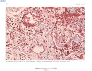 756 Patología especial
FIGURA 23-4. Displasia broncopulmonar. Hay proliferación fibroblástica con fibrosis intersticial y evidencia de regeneración de epitelio alveolar dañado.
© 2007 Editorial Médica Panamericana, S.A de C.V.
Cisfarm
 