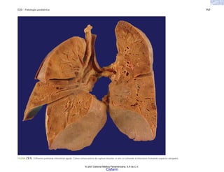 C23 Patología pediátrica 757
FIGURA 23-5. Enfisema pulmonar intersticial agudo. Como consecuencia de ruptura alveolar, el aire se extiende al intersticio formando espacios alargados.
© 2007 Editorial Médica Panamericana, S.A de C.V.
Cisfarm
 