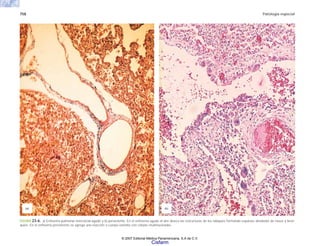 758 Patología especial
(a) (b)
FIGURA 23-6. a) Enfisema pulmonar intersticial agudo y b) persistente. En el enfisema agudo el aire diseca las estructuras de los tabiques formando espacios alrededor de vasos y bron-
quios. En el enfisema persistente se agrega una reacción a cuerpo extraño con células multinucleadas.
© 2007 Editorial Médica Panamericana, S.A de C.V.
Cisfarm
 