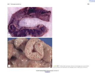 C23 Patología pediátrica 759
FIGURA 23-7. Enterocolitis necrosante. Necrosis hemorrágica de la pared intesti-
nal a) y evidencia de neumatosis con burbujas de aire visibles por la serosa b).
(a)
(b)
© 2007 Editorial Médica Panamericana, S.A de C.V.
Cisfarm
 