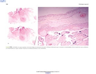 760 Patología especial
FIGURA 23-8. a) Onfalitis en sepsis neonatal. Corte del ombligo con ulceración de la piel e infiltrado inflamatorio que se extiende a la profundidad y afecta la pared de vasos umbilicales.
b) Corioamnionitis en sepsis neonatal. Placenta con infiltrado purulento en las membranas.
(b)
(a)
© 2007 Editorial Médica Panamericana, S.A de C.V.
Cisfarm
 