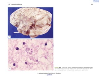 C23 Patología pediátrica 761
FIGURA 23-9. a) Infección cerebral neonatal por toxoplasma. Meningoencefalitis
por toxoplasmosis neonatal con extensas zonas de necrosis del parénquima alrede-
dor de la cisura de Silvio. b) Taquizoítos de toxoplasma en tejido cerebral.
(a)
(b)
© 2007 Editorial Médica Panamericana, S.A de C.V.
Cisfarm
 