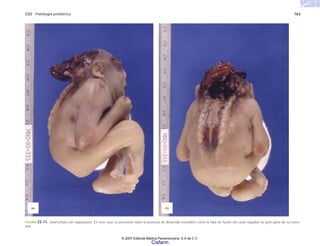 C23 Patología pediátrica 763
FIGURA 23-11. Anancefalia con raquisquisis. En este caso se presentan tanto la ausencia de desarrollo encefálico como la falta de fusión del canal raquídeo en gran parte de su exten-
sión.
(a) (b)
© 2007 Editorial Médica Panamericana, S.A de C.V.
Cisfarm
 