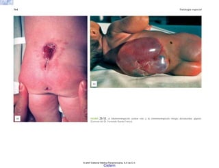 764 Patología especial
FIGURA 23-12. a) Mielomeningocele lumbar roto y b) mielomeningocele íntegro dorsolumbar gigante.
(Cortesía del Dr. Fernando Rueda Franco).
(b)
(a)
© 2007 Editorial Médica Panamericana, S.A de C.V.
Cisfarm
 