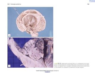 C23 Patología pediátrica 765
FIGURA 23-13. Malformación de Arnold-Chiari. a) La combinación de un menin-
gocele o mielomeningocele con hidrocefalia apunta a la presencia de esta malfor-
mación con dilatación de las cavidades ventriculares b) hernia del cerebelo hacia
el canal raquídeo con elongación y acodamiento del bulbo raquídeo.
(a)
(b)
© 2007 Editorial Médica Panamericana, S.A de C.V.
Cisfarm
 