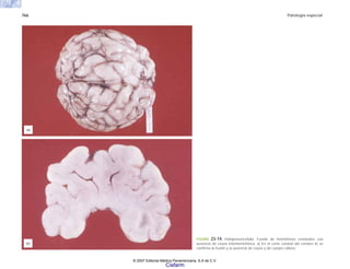766 Patología especial
(a)
FIGURA 23-14. Holoprosencefalia. Fusión de hemisferios cerebrales con
ausencia de cisura interhemisférica. a) En el corte coronal del cerebro b) se
confirma la fusión y la ausencia de cisura y de cuerpo calloso.
(b)
© 2007 Editorial Médica Panamericana, S.A de C.V.
Cisfarm
 