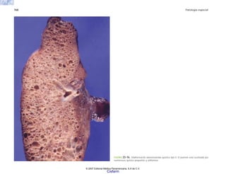 768 Patología especial
FIGURA 23-16. Malformación adenomatoide quística tipo II. El pulmón está sustituido por
numerosos quistes pequeños y uniformes.
© 2007 Editorial Médica Panamericana, S.A de C.V.
Cisfarm
 