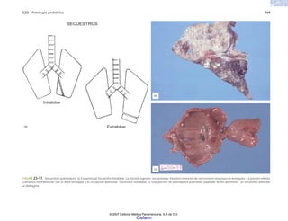 C23 Patología pediátrica 769
FIGURA 23-17. Secuestros pulmonares. a) Esquema. b) Secuestro intralobar. La porción superior, secuestrada, muestra retención de secreciones mucosas en bronquios. La porción inferior
comunica normalmente con el árbol bronquial y la circulación pulmonar. Secuestro extralobar. c) Una porción de parénquima pulmonar, separado de los pulmones, se encuentra adherido
al diafragma.
(c)
(b)
Intralobar
(a)
SECUESTROS
Extralobar
© 2007 Editorial Médica Panamericana, S.A de C.V.
Cisfarm
 