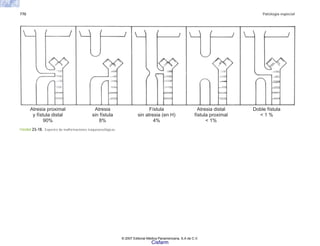 770 Patología especial
Atresia proximal
y fístula distal
90%
Atresia
sin fístula
8%
Fístula
sin atresia (en H)
4%
Atresia distal
fístula proximal
< 1%
Doble fístula
< 1 %
FIGURA 23-18. Espectro de malformaciones traqueoesofágicas.
© 2007 Editorial Médica Panamericana, S.A de C.V.
Cisfarm
 