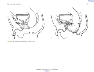 C23 Patología pediátrica 771
(a) (b)
FIGURA 23-19. Malformaciones anorrectales. a) Alta y b) baja.
© 2007 Editorial Médica Panamericana, S.A de C.V.
Cisfarm
 