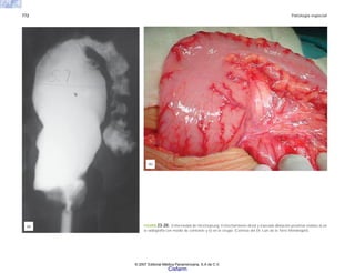 772 Patología especial
FIGURA 23-20. Enfermedad de Hirschsprung. Estrechamiento distal y marcada dilatación proximal visibles a) en
la radiografía con medio de contraste y b) en la cirugía. (Cortesía del Dr. Luis de la Torre Mondragón).
(a)
(b)
© 2007 Editorial Médica Panamericana, S.A de C.V.
Cisfarm
 