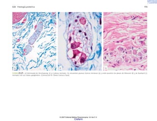 C23 Patología pediátrica 773
FIGURA 23-21. a) Enfermedad de Hirschsprung, b) y c) plexos normales. Se encuentran gruesos troncos nerviosos (a) y están ausentes los plexos de Meissner (b) y de Auerbach (c)
normales con sus células ganglionares. (Cortesía del Dr. Daniel Carrasco Daza).
(c)
(a) (b)
© 2007 Editorial Médica Panamericana, S.A de C.V.
Cisfarm
 