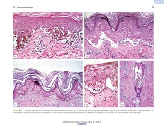 C5 Inmunopatología 73
FIGURA 5-11. Diversos aspectos de la histología de la dermatitis por contacto. a) y b), formación de vesículas intraepiteliales en ausencia de infiltrado inflamatorio, c) hiperqueratosis, un
acompañante habitual de esta forma de dermatitis, d) las células basales epiteliales permanecen adheridas a las papilas; e) los anexos de la piel también están afectados.
(a) (b)
(c) (d) (e)
© 2007 Editorial Médica Panamericana, S.A de C.V.
Cisfarm
 