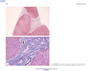 774 Patología especial
FIGURA 23-22. Fibrosis hepática congénita. El hígado muestra bandas fibrosas
bien delimitadas a) en cuyo seno hay conductos biliares hamartomatosos b).
(a)
(b)
© 2007 Editorial Médica Panamericana, S.A de C.V.
Cisfarm
 