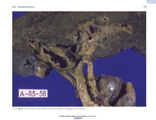 C23 Patología pediátrica 775
FIGURA 23-23. Enfermedad de Caroli. Dilatación de conductos biliares intrahepáticos cerca del hilio.
© 2007 Editorial Médica Panamericana, S.A de C.V.
Cisfarm
 