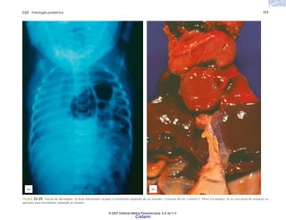 C23 Patología pediátrica 777
FIGURA 23-25. Hernia de Bochdalek. a) Asas intestinales ocupan el hemitórax izquierdo de un neonato. (Cortesía del Dr. Lorenzo F. Pérez Fernández). b) En una pieza de autopsia se
aprecian asas intestinales rodeando al corazón
(b)
(a)
© 2007 Editorial Médica Panamericana, S.A de C.V.
Cisfarm
 