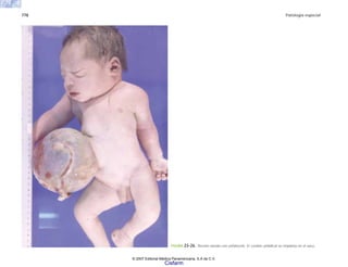 778 Patología especial
FIGURA 23-26. Recién nacido con onfalocele. El cordón umbilical se implanta en el saco.
© 2007 Editorial Médica Panamericana, S.A de C.V.
Cisfarm
 