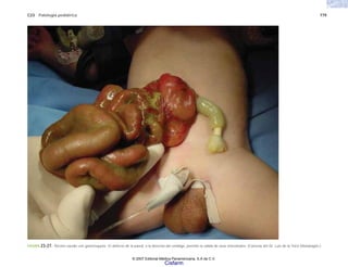 C23 Patología pediátrica 779
FIGURA 23-27. Recién nacido con gastrosquisis. El defecto de la pared, a la derecha del ombligo, permite la salida de asas intestinales. (Cortesía del Dr. Luis de la Torre Mondragón.)
© 2007 Editorial Médica Panamericana, S.A de C.V.
Cisfarm
 