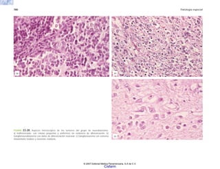 780 Patología especial
FIGURA 23-28. Aspecto microscópico de los tumores del grupo de neuroblastoma.
a) Indiferenciado, con células pequeñas y uniformes sin evidencia de diferenciación. b)
Ganglioneuroblastoma con datos de diferenciación neuronal. c) Ganglioneuroma con estroma
shwanniano maduro y neuronas maduras.
(a) (b)
(c)
© 2007 Editorial Médica Panamericana, S.A de C.V.
Cisfarm
 