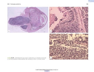 C23 Patología pediátrica 781
FIGURA 23-29. a) Retinoblastoma que ocupa la cavidad vítrea y se extiende al nervio ópti-
co. b) Está formado por células pequeñas que sustituyen la retina, c) y forman rosetas.
(a) (b)
(c)
© 2007 Editorial Médica Panamericana, S.A de C.V.
Cisfarm
 