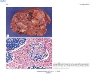 782 Patología especial
FIGURA 23-30. Hepatoblastoma a) Aspecto macroscópico con sustitución
extensa del parénquima hepático por un crecimiento tumoral heterogéneo. b)
Aspecto microscópico de un hepatoblastoma mixto con alternancia de células
epiteliales poco diferenciadas y tejido mesenquimatoso con depósito de osteoi-
de, azul en esta tinción tricrómica.
(a)
(b)
© 2007 Editorial Médica Panamericana, S.A de C.V.
Cisfarm
 