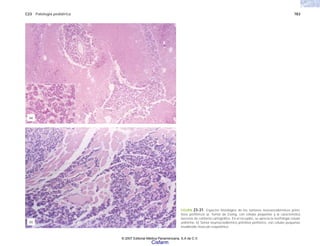 C23 Patología pediátrica 783
FIGURA 23-31. Espectro histológico de los tumores neuroecodérmicos primi-
tivos periféricos a). Tumor de Ewing, con células pequeñas y la característica
necrosis de contorno cartográfico. En el recuadro, se aprecia la morfología celular
uniforme. b) Tumor neuroectodérmico primitivo periférico, con células pequeñas
invadiendo músculo esquelético.
(b)
(a)
© 2007 Editorial Médica Panamericana, S.A de C.V.
Cisfarm
 