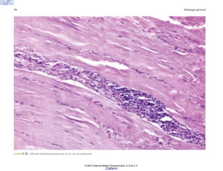 74 Patología general
FIGURA 5-12. Infiltrado inflamatorio perivascular en un caso de polimiositis.
© 2007 Editorial Médica Panamericana, S.A de C.V.
Cisfarm
 